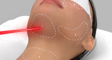Endolift Lazer