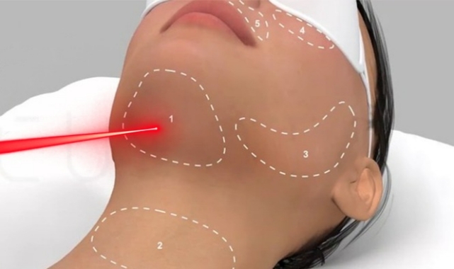 Endolift Lazer